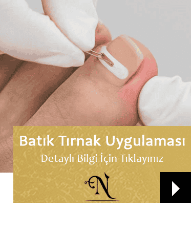 Batık Tırnak Uygulaması | Isparta Güzellik Merkezi